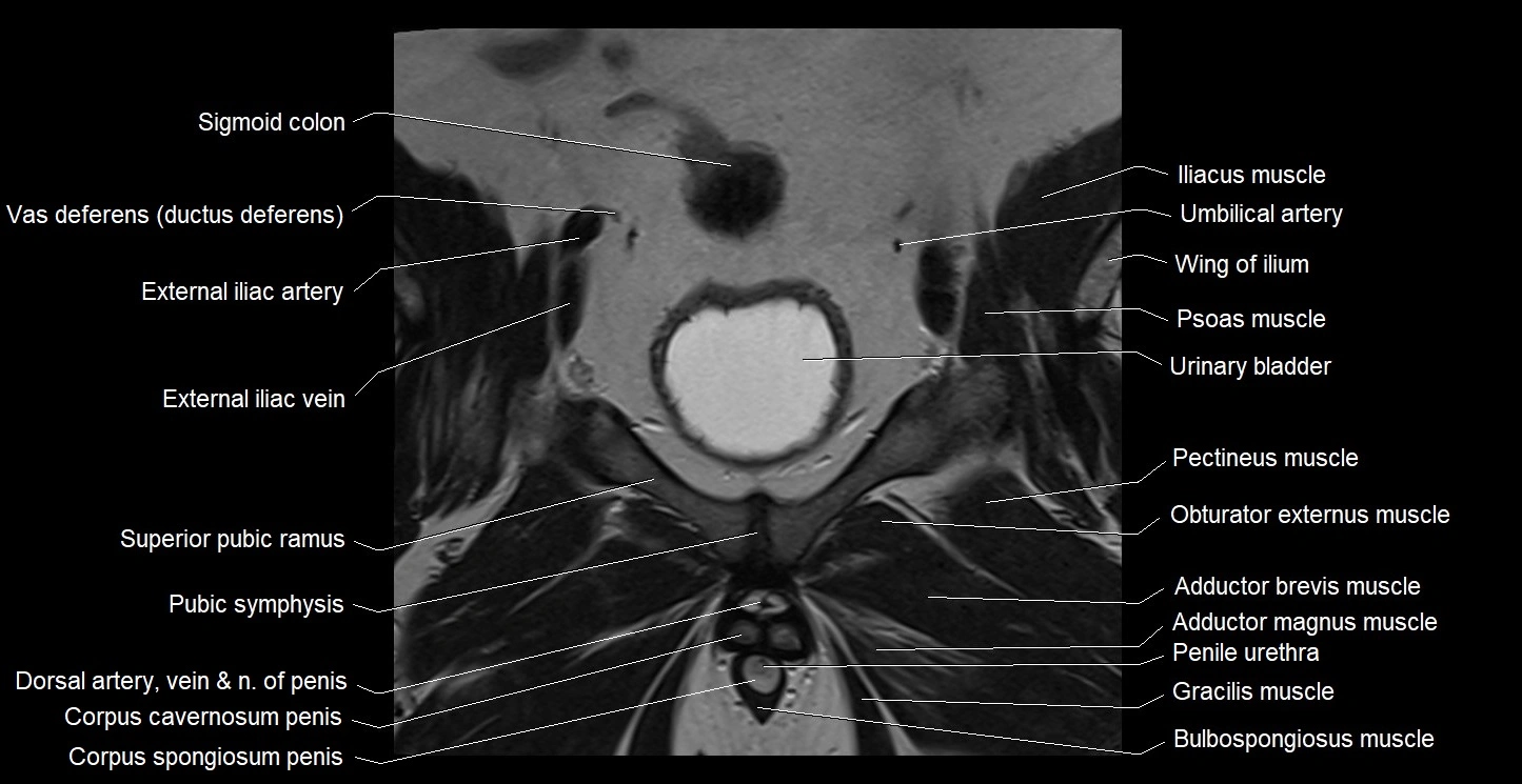 MRI coronal cross sectional anatomy male pelvis image 12.webp